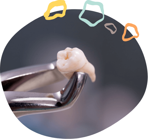 Dental clasp holding an extracted tooth