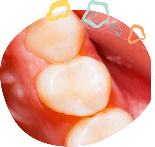 Close up of row of teeth with white fillings